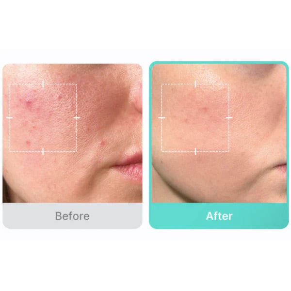 [Medicube] Azelaic Acid 16% BB Calming Serum 30ML